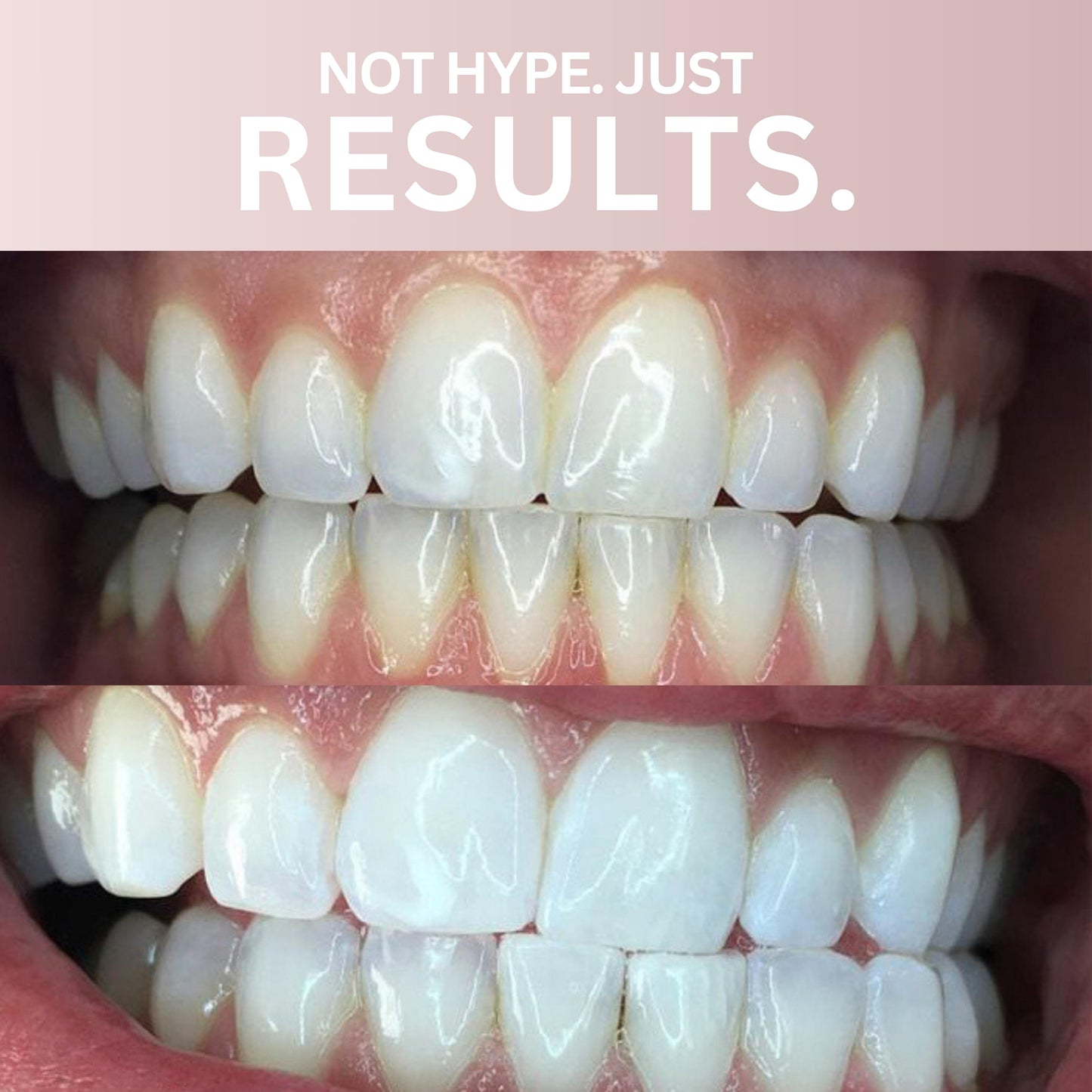 Teeth Whitening Strips